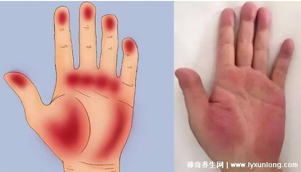 肝掌图片高清图片