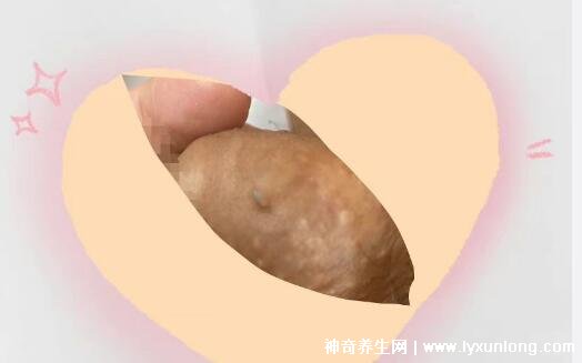 男性早期图片尖湿锐尤,下面长尖尖的各种形态症状(有图慎入)