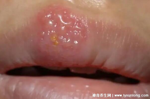疱疹和上火水泡的区别图片