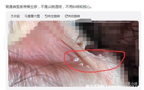 男性早期图片尖湿锐尤,下面长尖尖的各种形态症状(有图慎入)