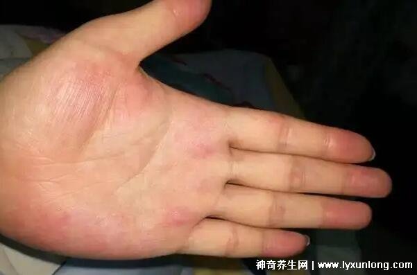 肝掌图片高清图片
