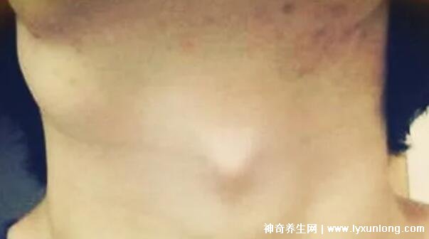 颈部淋巴癌早期症状图片高清,可滑动肿块不痛痒