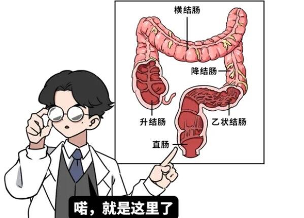 直肠癌早期拉屎照片