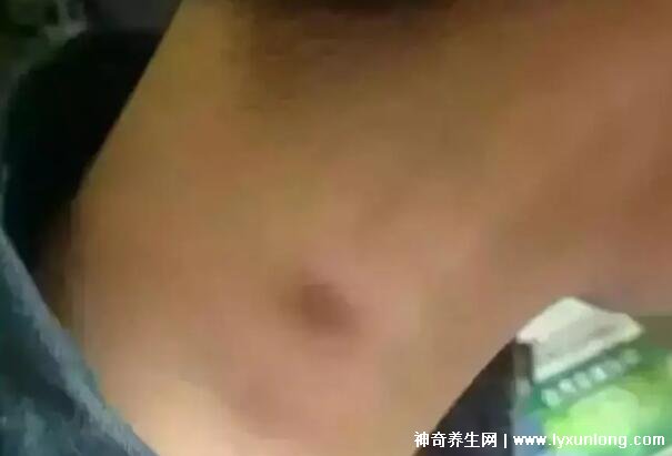 颈部淋巴癌早期症状图片高清,可滑动肿块不痛痒