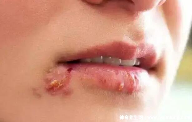 疱疹和上火水泡的区别图片