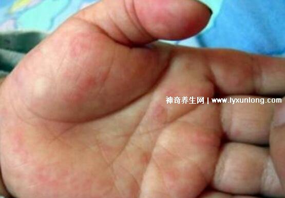 小儿手足口病最早期图片