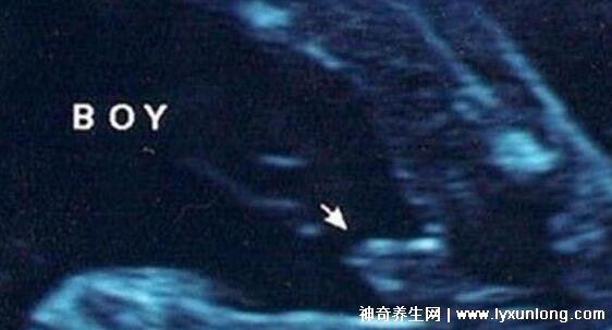 b超有两点基本是男孩