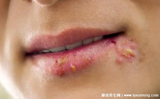 疱疹和上火水泡的区别图片