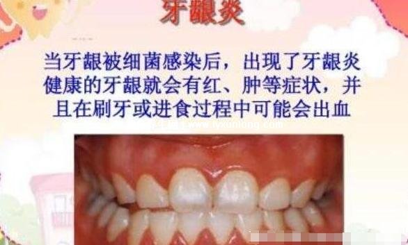牙龈出血要警惕三种病