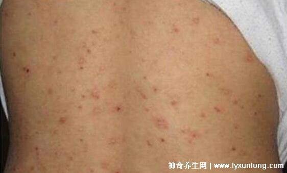 螨虫咬了是什么样子图