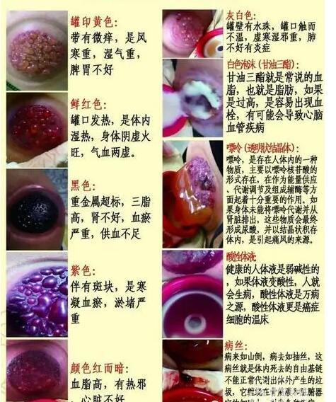 拔罐后湿气重图片,颜色黑紫局部有水珠多有寒湿