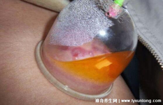 拔罐后湿气重图片,颜色黑紫局部有水珠多有寒湿