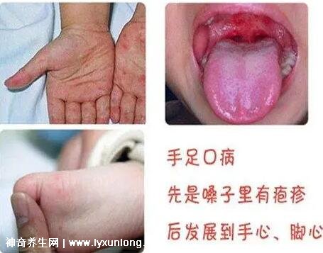 小儿手足口病最早期图片