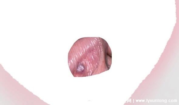 男性早期图片尖湿锐尤,下面长尖尖的各种形态症状(有图慎入)