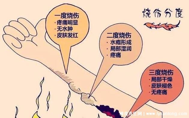 烧伤面积口诀三三三五六七