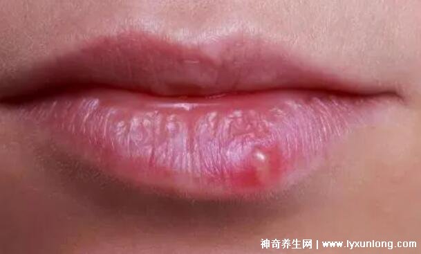 疱疹和上火水泡的区别图片
