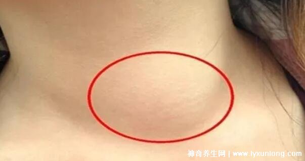 颈部淋巴癌早期症状图片高清,可滑动肿块不痛痒