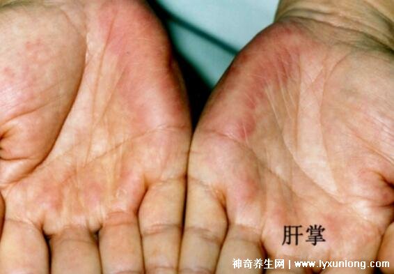 肝掌图片高清图片