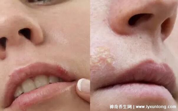 疱疹和上火水泡的区别图片