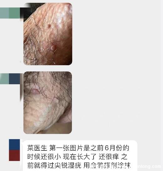 男性早期图片尖湿锐尤,下面长尖尖的各种形态症状(有图慎入)