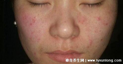 螨虫咬了是什么样子图