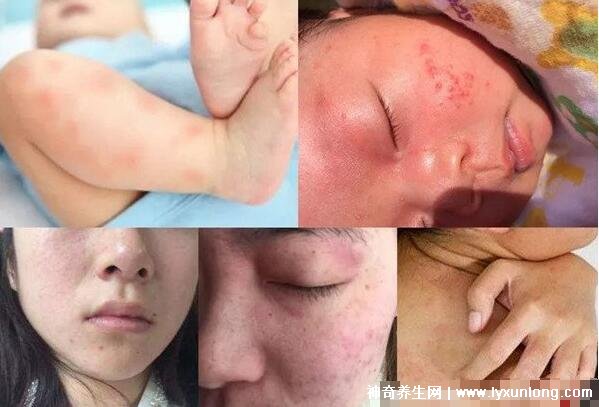 螨虫咬了是什么样子图