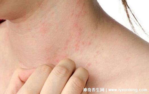 螨虫咬了是什么样子图