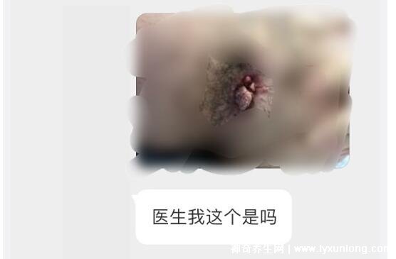 男性早期图片尖湿锐尤,下面长尖尖的各种形态症状(有图慎入)