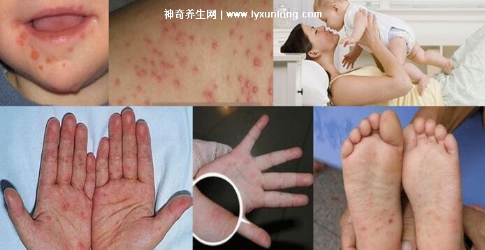 小儿手足口病最早期图片