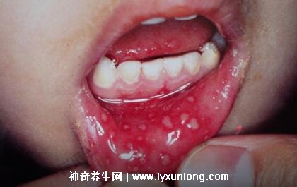 小儿手足口病最早期图片