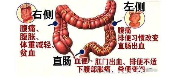 直肠癌早期拉屎照片