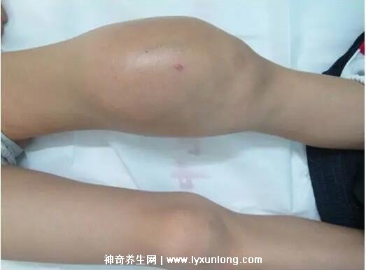 骨癌早期有三处痛图片,就有背部和关节疼痛(晚上持续性钝痛)