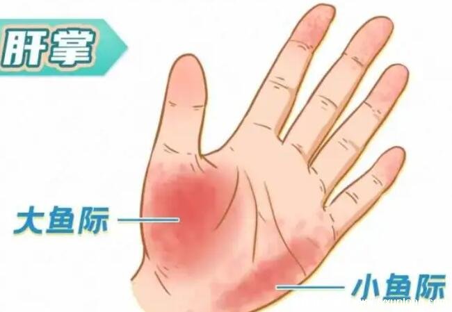 肝掌图片高清图片