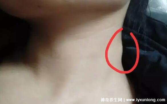 颈部淋巴癌早期症状图片高清,可滑动肿块不痛痒