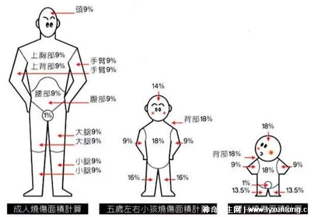烧伤面积口诀三三三五六七
