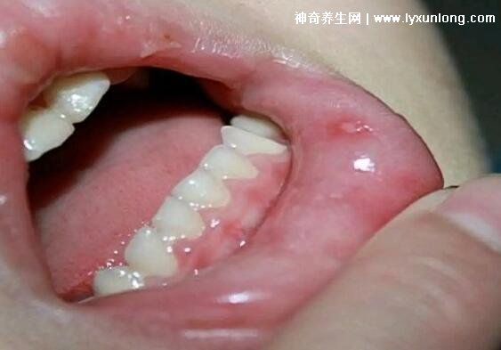 小儿手足口病最早期图片