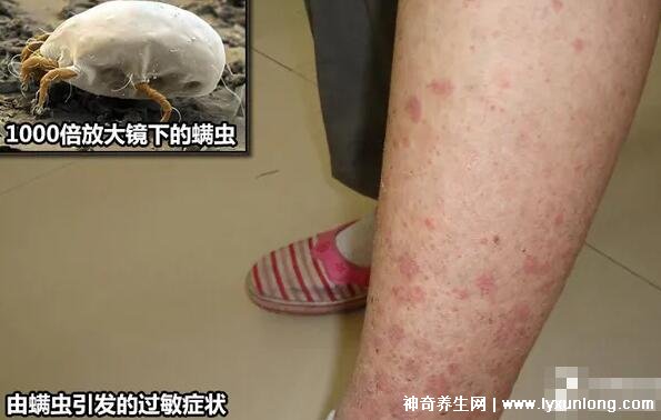 螨虫咬了是什么样子图