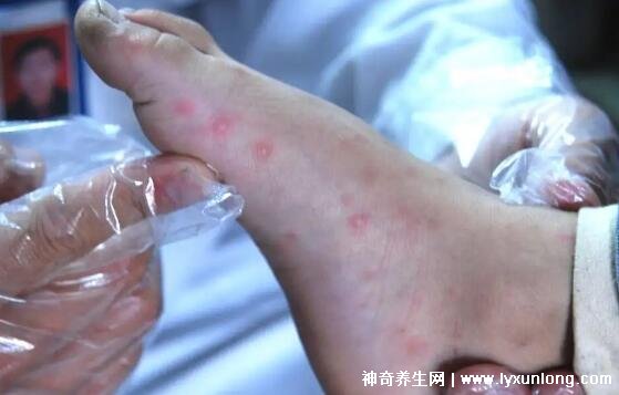 小儿手足口病最早期图片