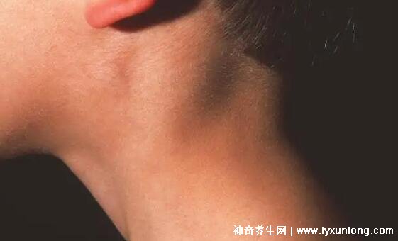 颈部淋巴癌早期症状图片高清,可滑动肿块不痛痒