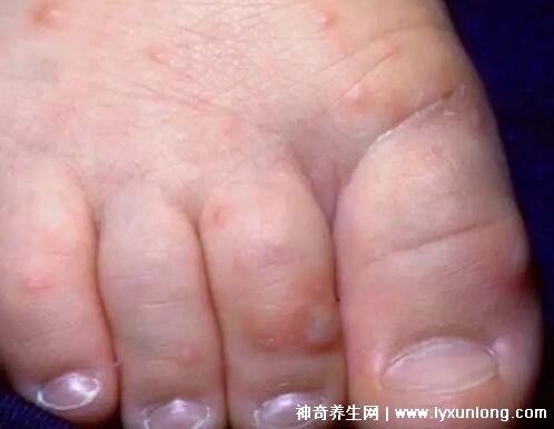 小儿手足口病最早期图片